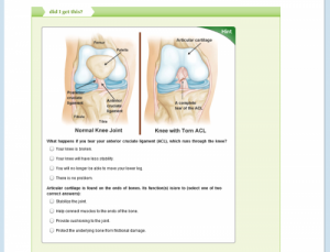 picture of a textbook page with 2 side by side illustrations of a healthy knee joint, and one with a torn acl. 2 sets of multiplet choice questions below.